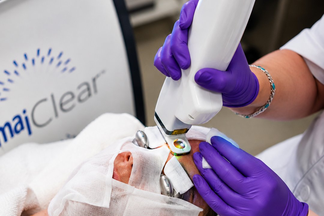 Traitement esthétique du visage au laser